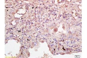 Formalin-fixed and paraffin embedded human lung tissue labeled with Rabbit Anti-IL-2R gamma Polyclonal Antibody  at 1:200 followed by conjugation to the secondary antibody and DAB staining. (IL2RG antibody  (AA 51-150))