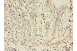 Immunohistochemistry of paraffin-embedded human breast cancer using ABIN7157158 at dilution of 1:100 (JUP antibody  (AA 1-131))