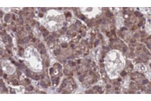 ABIN6273912 at 1/100 staining Human liver cancer tissue by IHC-P. (GPR77 antibody  (C-Term))