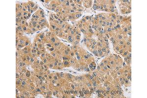 Immunohistochemistry of Human liver cancer using ARHGAP15 Polyclonal Antibody at dilution of 1:50