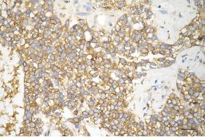 Immunohistochemistry was performed on paraffin-embedded human breast carcinoma using phospho-eIF4B (S406) antibody (ABIN7798527), 1:200). (Recombinant EIF4B antibody  (pSer406))