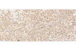 Immunohistochemistry of paraffin-embedded Human ovarian cancer tissue using PADI4 Polyclonal Antibody at dilution of 1:35(x200) (PAD4 antibody)