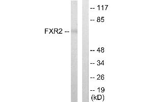 Immunohistochemistry analysis of paraffin-embedded human lung carcinoma tissue using FXR2 antibody. (FXR2 antibody  (Internal Region))