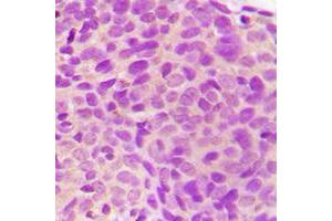 Immunohistochemical analysis of MST3 staining in human breast cancer formalin fixed paraffin embedded tissue section. (STK24 antibody  (C-Term))