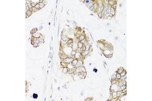 Immunohistochemistry of paraffin-embedded human gastric cancer using IER3 antibody at dilution of 1:100 (x40 lens). (IER3 antibody)