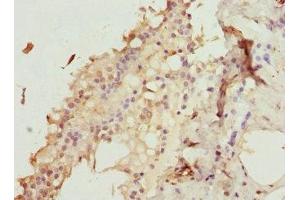 Immunohistochemistry of paraffin-embedded human breast cancer using ABIN7176187 at dilution of 1:100 (ZNF24 antibody  (AA 169-368))