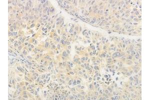 ABIN6264552 and ABIN6276570 at 1/100 staining human lung squamous cell carcinoma by IHC-P. (RAB11A antibody  (C-Term))