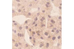 Immunohistochemical staining of human liver cancer tissue section with CXCL10 monoclonal antibody, clone 1  at 1:10 dilution. (CXCL10 antibody)