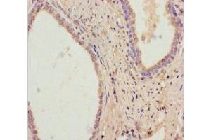 Immunohistochemistry of paraffin-embedded human prostate cancer using ABIN7167832 at dilution of 1:100 (RDH11 antibody  (AA 22-318))