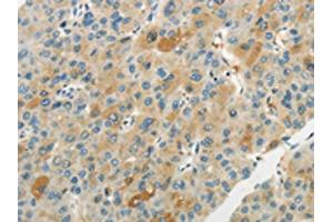 The image on the left is immunohistochemistry of paraffin-embedded Human liver cancer tissue using ABIN7193065(WNT2B Antibody) at dilution 1/20, on the right is treated with synthetic peptide. (WNT2B antibody)