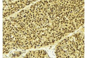 ABIN6268873 at 1/100 staining Human breast cancer tissue by IHC-P. (DREAM antibody  (Internal Region))
