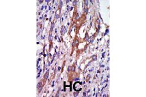 Formalin-fixed and paraffin-embedded human hepatocellular carcinoma tissue reacted with AURKA polyclonal antibody  , which was peroxidase-conjugated to the secondary antibody, followed by DAB staining. (Aurora A antibody  (N-Term))