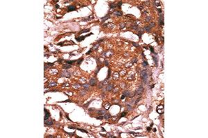 Formalin-fixed and paraffin-embedded human cancer tissue reacted with the primary antibody, which was peroxidase-conjugated to the secondary antibody, followed by AEC staining. (GUCY1A1 antibody  (N-Term))