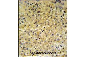 INSC Antibody IHC analysis in formalin fixed and paraffin embedded hepatocarcinoma followed by peroxidase conjugation of the secondary antibody and DAB staining. (INSC antibody  (AA 410-437))