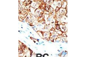 Formalin-fixed and paraffin-embedded human cancer tissue reacted with the primary antibody, which was peroxidase-conjugated to the secondary antibody, followed by AEC staining. (Ubiquilin 1 antibody  (AA 296-326))