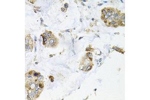 Immunohistochemistry of paraffin-embedded human gastric cancer using GALC antibody at dilution of 1:100 (x40 lens). (GALC antibody)