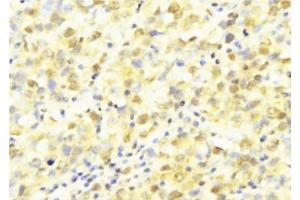 ABIN6277569 at 1/100 staining Human breast cancer tissue by IHC-P. (HUS1 antibody  (Internal Region))