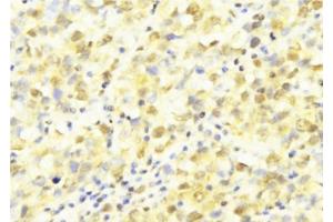 ABIN6277569 at 1/100 staining Human breast cancer tissue by IHC-P.