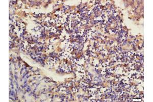 Formalin-fixed and paraffin embedded human laryngo carcinoma labeled with Rabbit Anti-DNAJB12 Polyclonal Antibody, Unconjugated (ABIN2173711) at 1:200 followed by conjugation to the secondary antibody and DAB staining (DNAJB12 antibody  (AA 26-130))