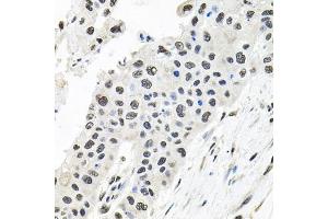 Immunohistochemistry of paraffin-embedded human lung cancer using CDCA8 antibody (ABIN6290179) at dilution of 1:100 (40x lens).