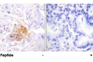 Immunohistochemical analysis of paraffin-embedded human lung carcinoma tissue using IL2RB polyclonal antibody .
