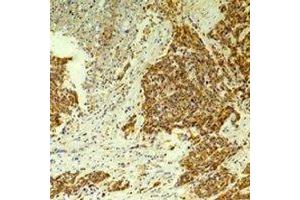 Immunohistochemical analysis of CLIC4 staining in human breast cancer,rat brain formalin fixed paraffin embedded tissue section. (CLIC4 antibody)