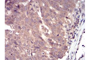 Immunohistochemical analysis of paraffin-embedded ovarian cancer tissues using SLINGSHOT-1L mouse mAb with DAB staining. (SSH1 antibody  (AA 1032-1044))