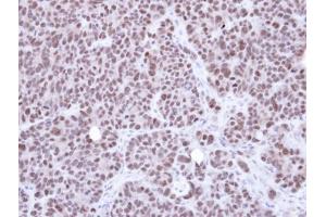 IHC-P Image Immunohistochemical analysis of paraffin-embedded SW480 xenograft, using NSMCE1, antibody at 1:500 dilution. (NSMCE1 antibody  (Center))