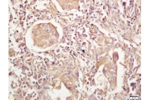 Formalin-fixed and paraffin embedded human lung carcinoma labeled with Rabbit Anti-MHC Class II Polyclonal Antibody, Unconjugated  at 1:200 followed by conjugation to the secondary antibody and DAB staining