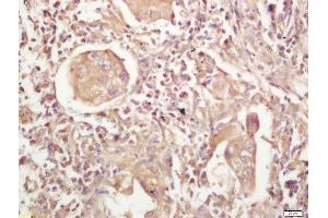 Formalin-fixed and paraffin embedded human lung carcinoma labeled with Rabbit Anti-MHC Class II Polyclonal Antibody, Unconjugated  at 1:200 followed by conjugation to the secondary antibody and DAB staining (MHC Class II antibody  (AA 111-200))