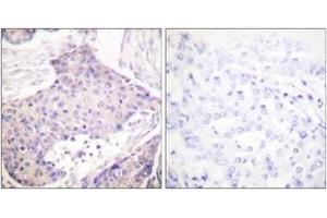 Immunohistochemistry analysis of paraffin-embedded human breast carcinoma tissue, using CARD6 Antibody. (CARD6 antibody  (AA 1-50))