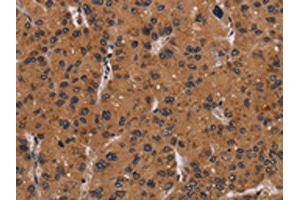 The image on the left is immunohistochemistry of paraffin-embedded Human liver cancer tissue using ABIN7191712(NRAS Antibody) at dilution 1/40, on the right is treated with synthetic peptide.