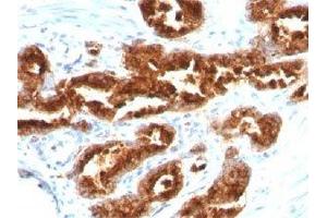 IHC staining of human prostate carcinoma with TAG-72 antibody