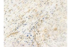 ABIN6257817 and ABIN6274533 at 1/100 staining human prostate carcinoma by IHC-P. (HMG20B antibody  (N-Term))