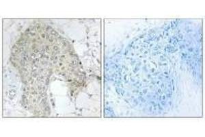 Immunohistochemistry analysis of paraffin-embedded human breast carcinoma tissue using PPP1R2 (Ab-120/121) antibody. (PPP1R2 antibody  (Ser120, Ser121))