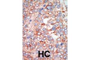 Formalin-fixed and paraffin-embedded human cancer tissue reacted with the primary antibody, which was peroxidase-conjugated to the secondary antibody, followed by AEC staining. (STK24 antibody  (C-Term))