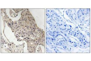 Immunohistochemistry analysis of paraffin-embedded human breast carcinoma tissue, using Gab2 (Phospho-Ser623) antibody. (GAB2 antibody  (pSer623))