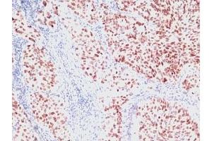 Formalin-fixed, paraffin-embedded human lung carcinoma stained with NKX2.
