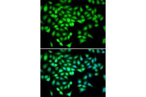 Immunohistochemistry of paraffin-embedded human kidney cancer using DDX21 antibody at dilution of 1:100 (40x lens). (DDX21 antibody)