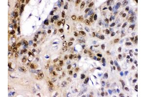 TCF7L1 was detected in paraffin-embedded sections of human oesophagus squama cancer tissues using rabbit anti- TCF7L1 Antigen Affinity purified polyclonal antibody at 1 μg/mL. (TCF7L1 antibody  (C-Term))