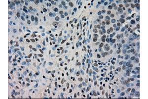 Immunohistochemical staining of paraffin-embedded Adenocarcinoma of breast tissue using anti-DHFR mouse monoclonal antibody.