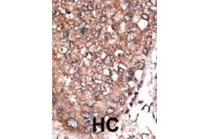 Formalin-fixed and paraffin-embedded human cancer tissue reacted with the primary antibody, which was peroxidase-conjugated to the secondary antibody, followed by AEC staining. (HAND2 antibody  (C-Term))