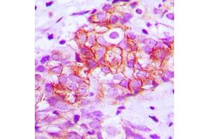 Immunohistochemical analysis of E Cadherin staining in human breast cancer formalin fixed paraffin embedded tissue section. (E-cadherin antibody  (C-Term))