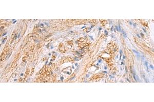Immunohistochemistry of paraffin-embedded Human gastric cancer tissue using TMOD3 Polyclonal Antibody at dilution of 1:70(x200) (TMOD3 antibody)