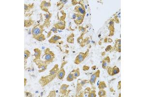 Immunohistochemistry of paraffin-embedded human liver cancer using BTD antibody at dilution of 1:100 (40x lens). (BTD antibody)