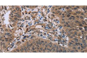 Immunohistochemistry of paraffin-embedded Human lung cancer using HOMER1 Polyclonal Antibody at dilution of 1:50 (HOMER1 antibody)