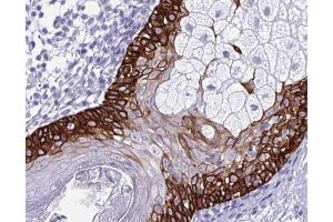 ABIN6266574 at 1/100 staining human colon cancer tissue by IHC-P. (Cytokeratin 5 antibody  (C-Term))