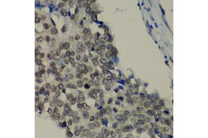 Immunohistochemistry of paraffin-embedded human lung cancer using TEAD1 antibody at dilution of 1:100 (x40 lens). (TEAD1 antibody)