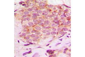 Immunohistochemical analysis of Mammaglobin A staining in human breast cancer formalin fixed paraffin embedded tissue section.