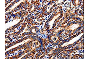 The image is immunohistochemistry of paraffin-embedded Human thyroid cancer tissue using ABIN7129012(COX19 Antibody) at dilution 1/50. (COX19 antibody)